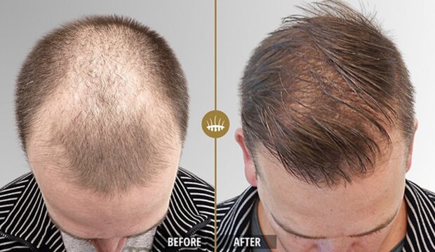 Hair Regrowth Serum for Men